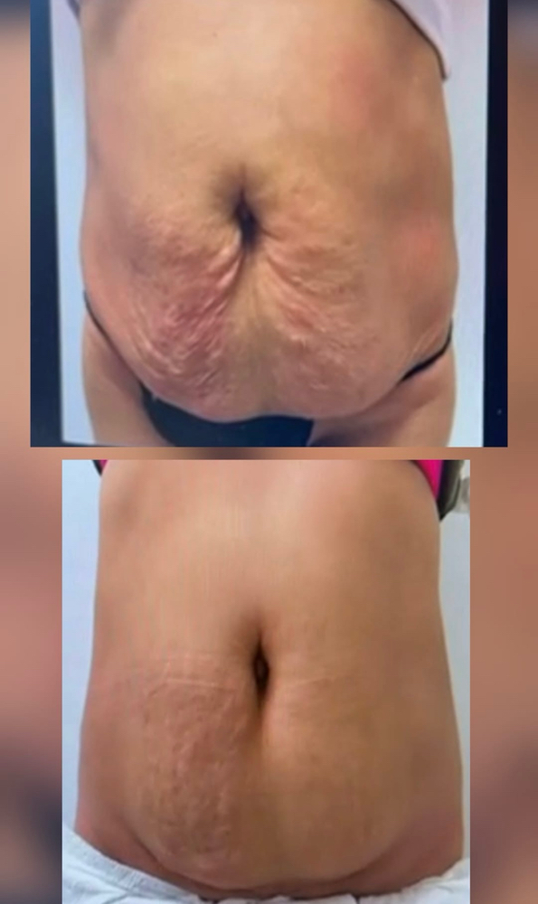 Lipoflack/ Quemador De Grasa