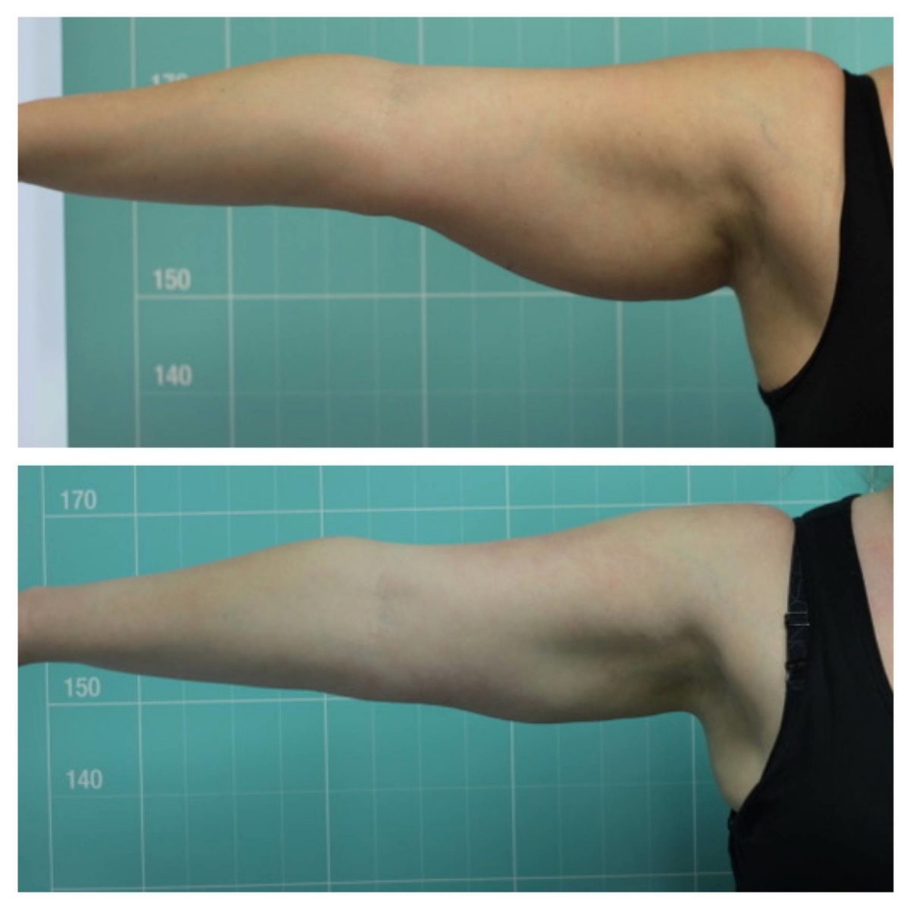 (4 ) LIPO CAVITATION ARMS