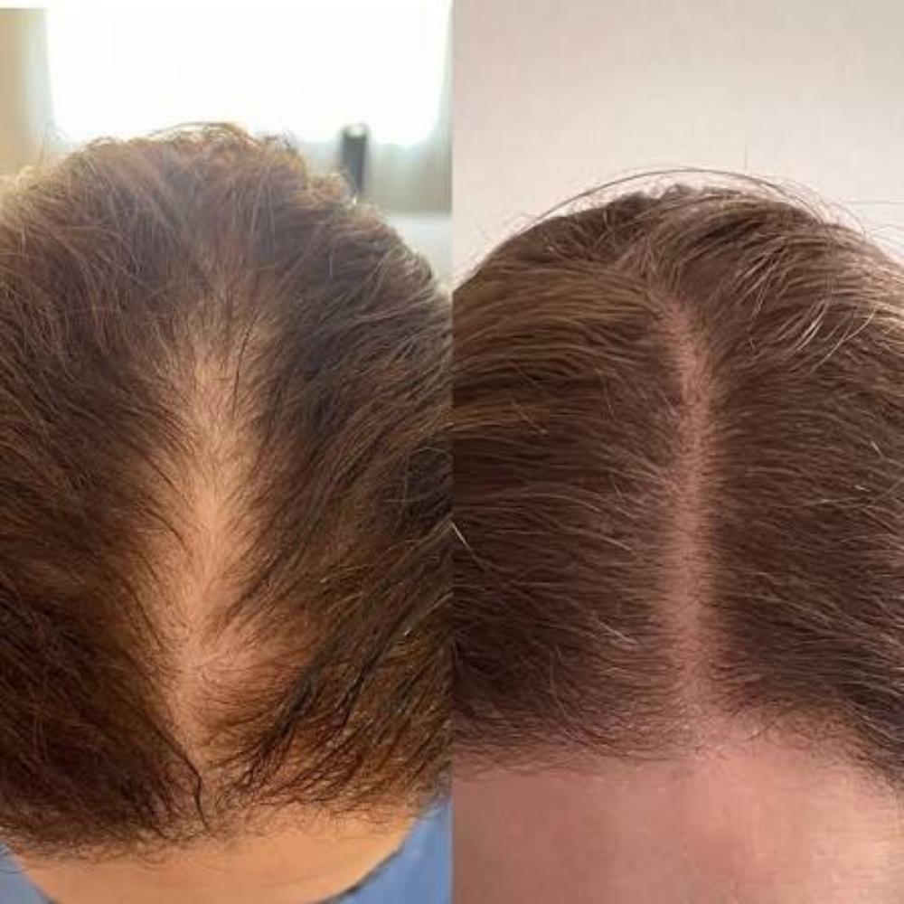 Tru Hair RESTORATION at Tru Beaute Aesthetics Med Spa in Houston, TX