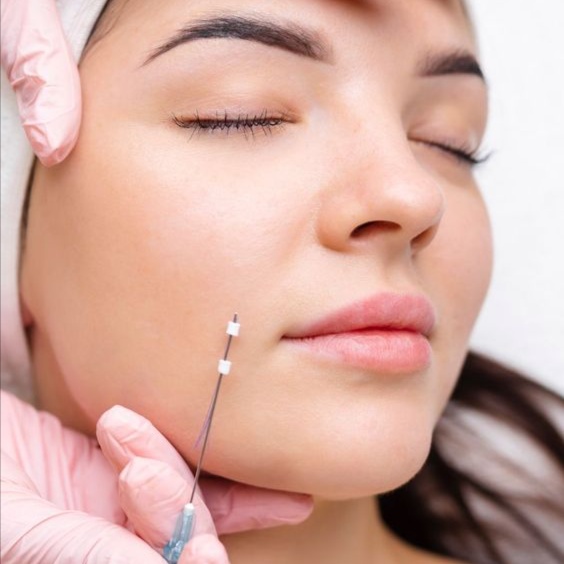 PDO Threads at AGELESS SKIN BY ASEEL MED SPA in Prosper, TX