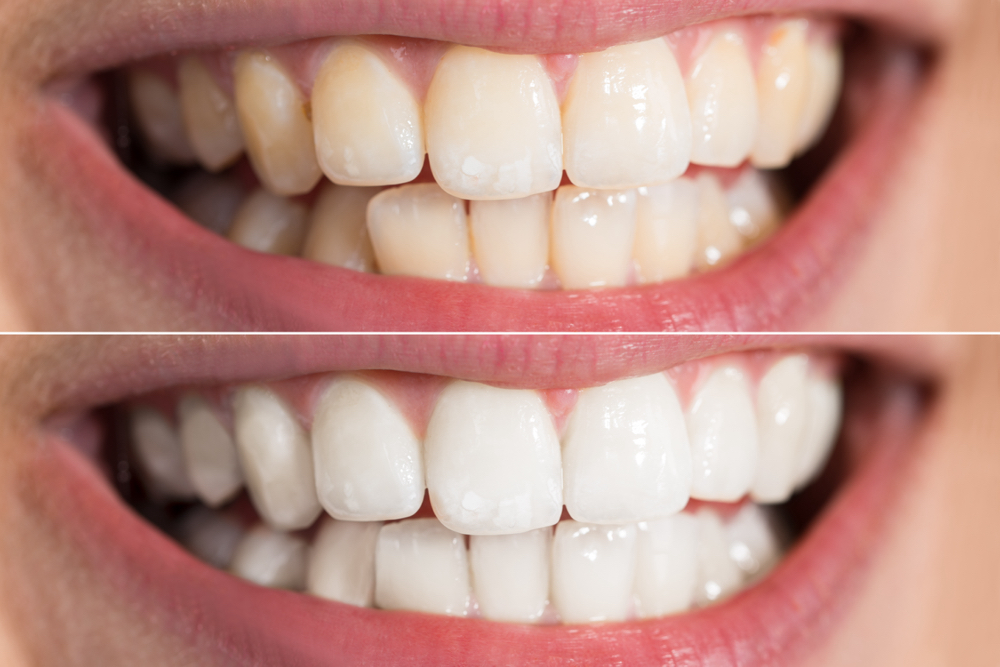 LED Teeth Whitening