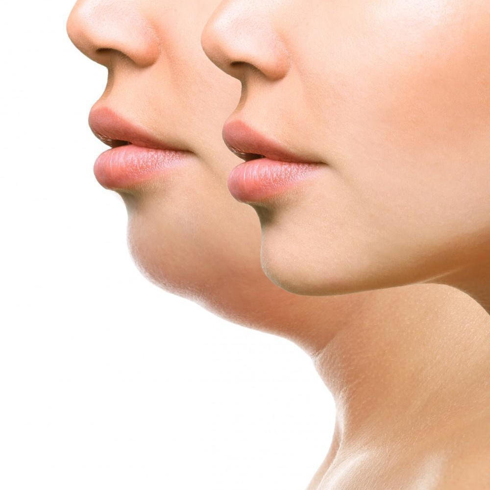 Skinny Shots Lipo (Chin)RF