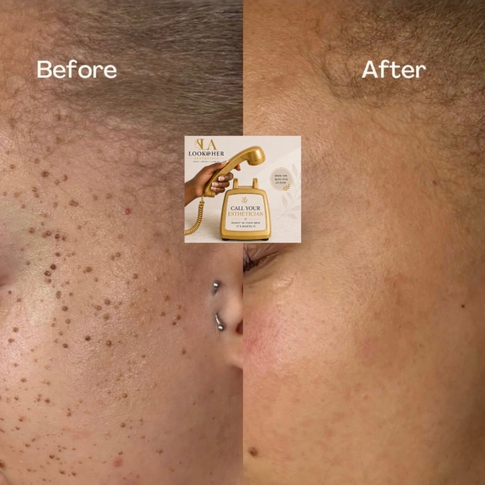SkinTag/Mole  Removal Full Face at LOOKATHER SKINBODY&LASHES AESTHETICS in Roswell, GA