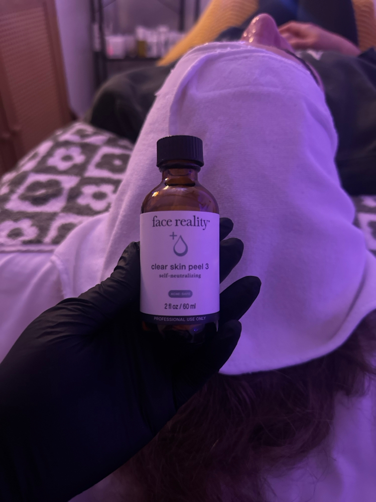 Radiant Glow | Custom Chemical Peel