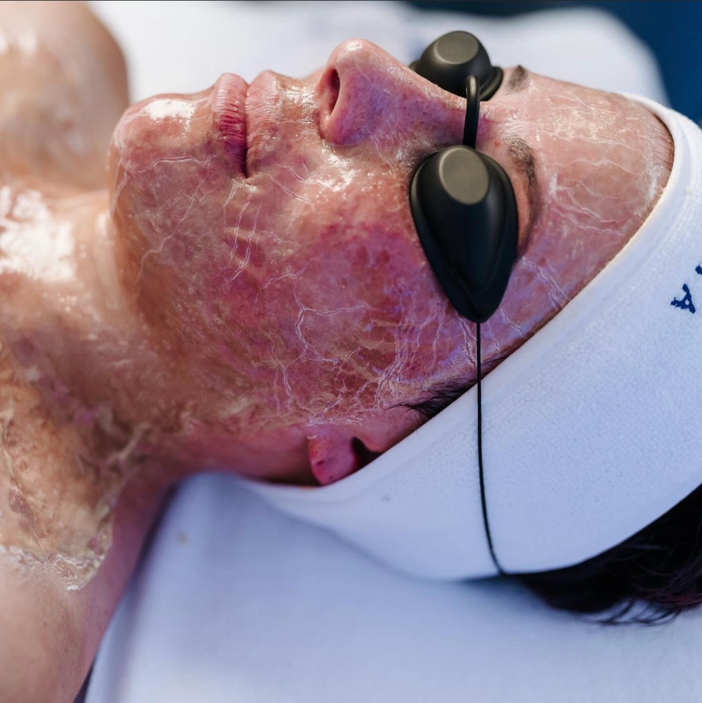 Rejuvenating Botox Facial