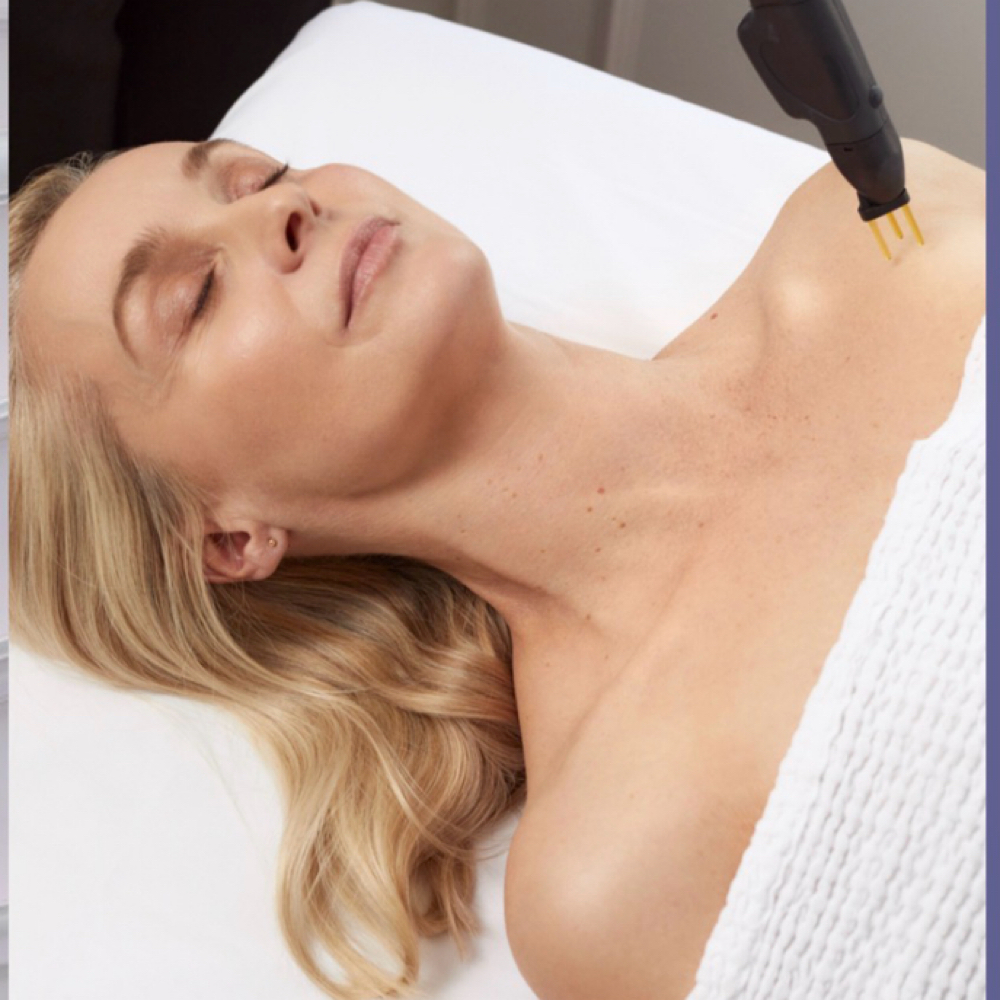 NeoGen Plasma – Full Face (Low Ener at Lone Tree Aesthetics in Lone Tree, CO