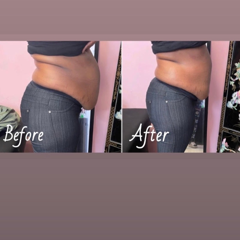 Lasor Lipo + Cavitation at Cozy Braids in SOUTHAVEN, MS
