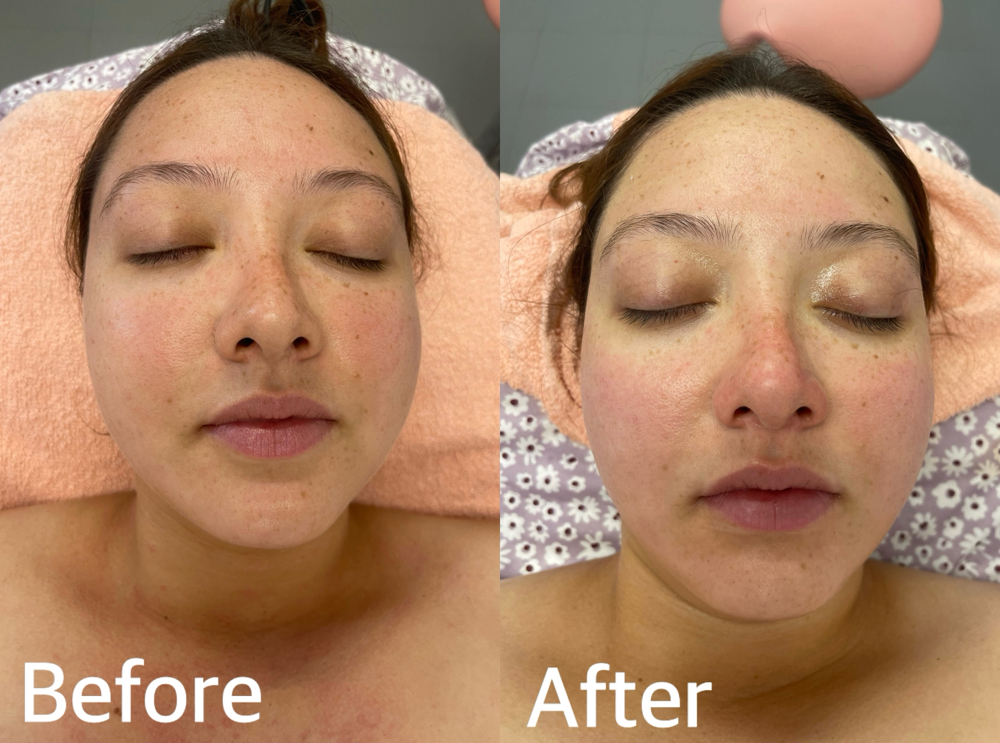 HydraFacial