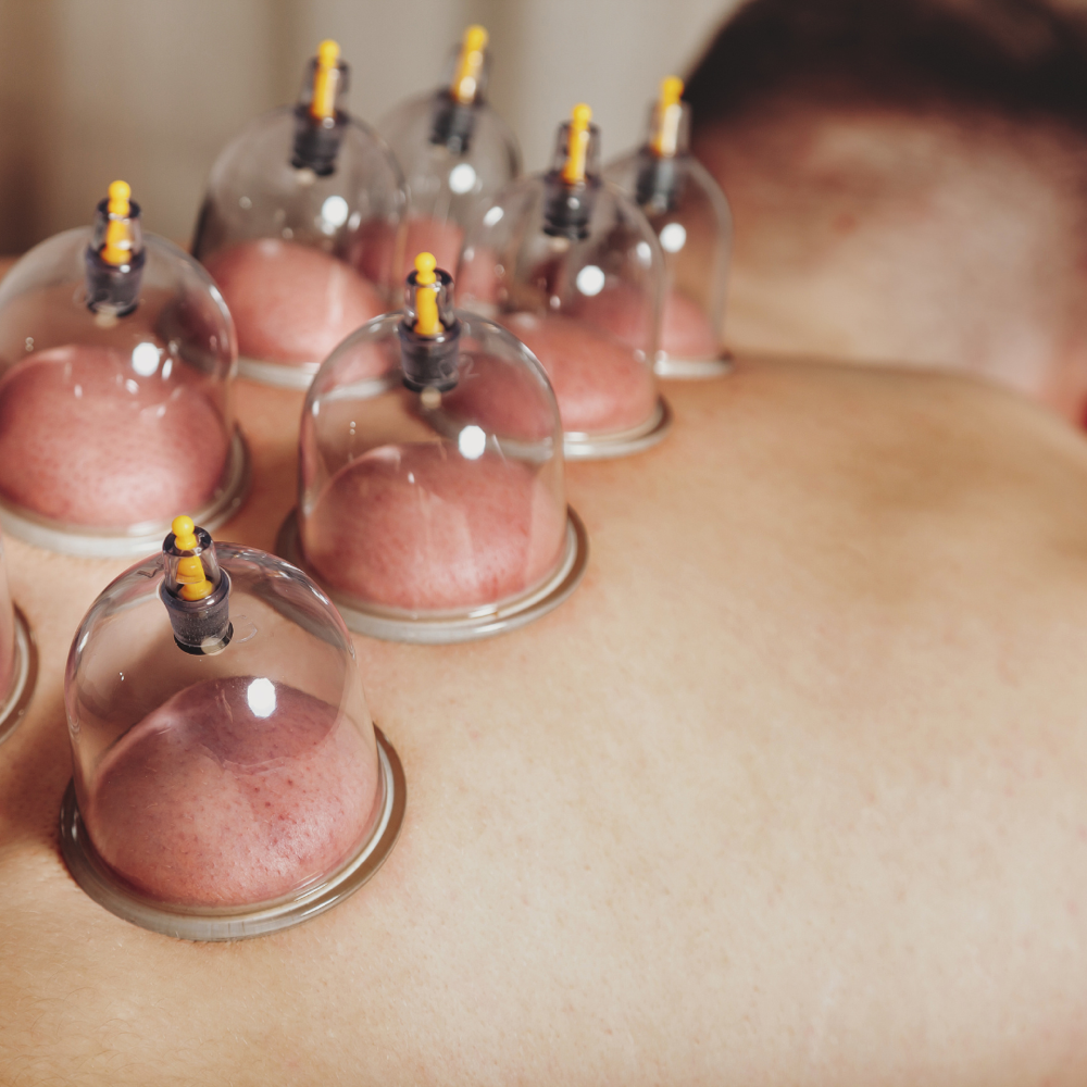 Cupping