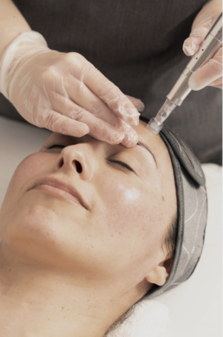 Pro Microneedling Package (Gold)
