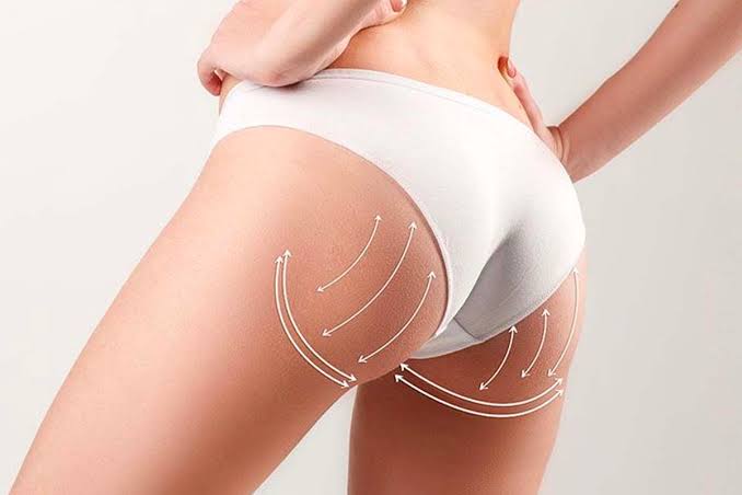 Fractional Radiofrequency Buttocks at Leidy Cornelio Spa in Aurora, CO