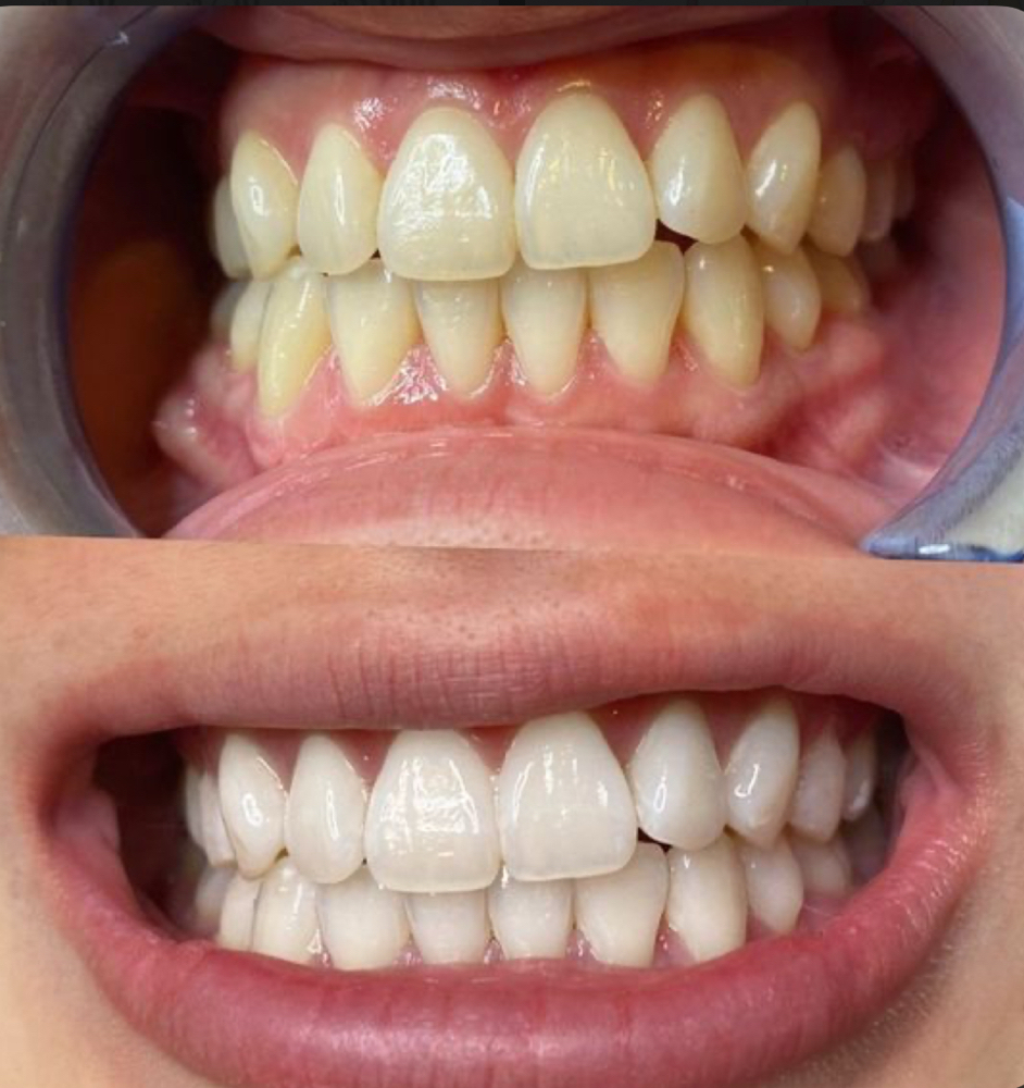Teeth Whitening