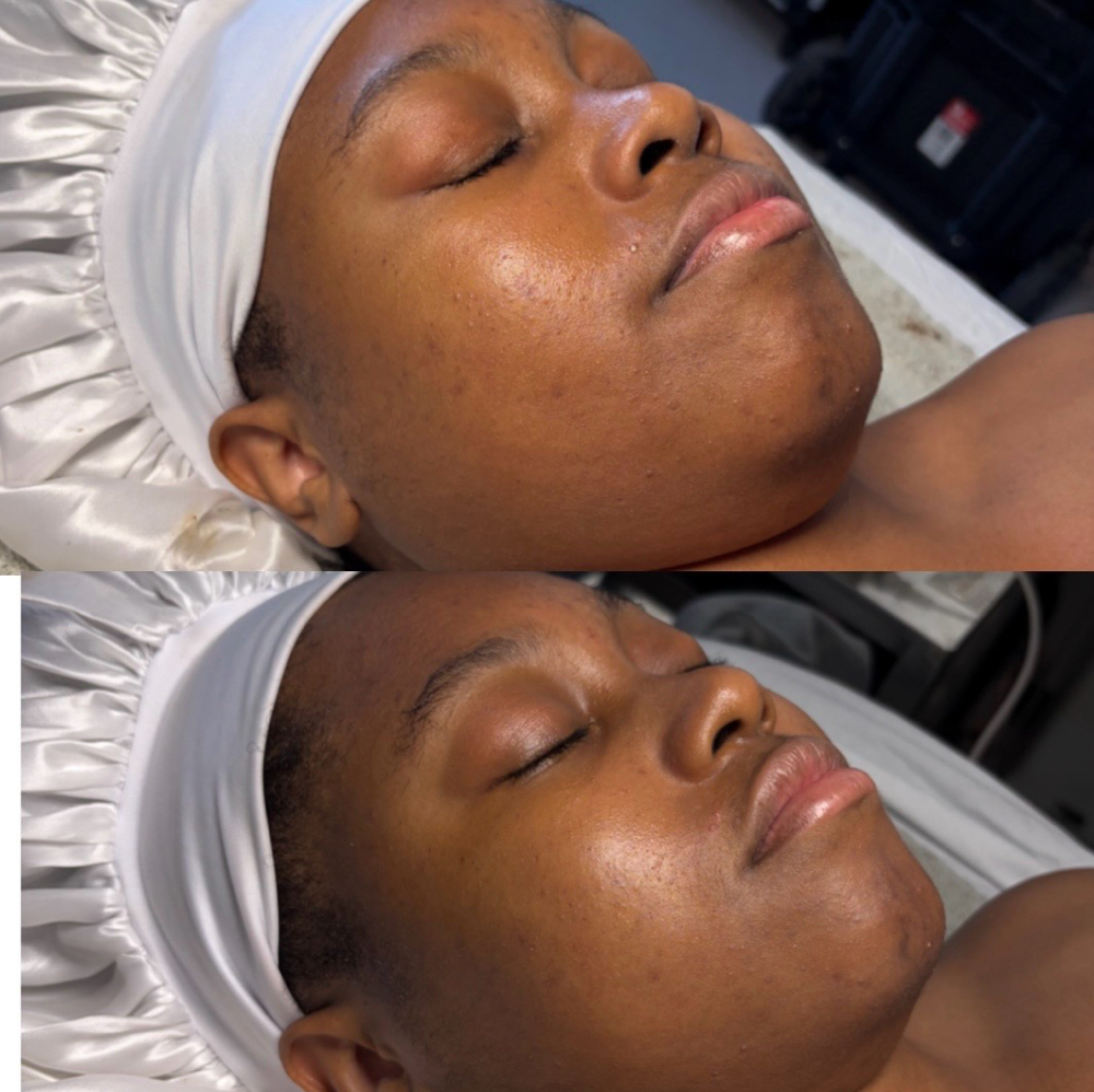 Microdermabrasion Facial at Vintage Kitty Esthetics in Los Angeles, CA