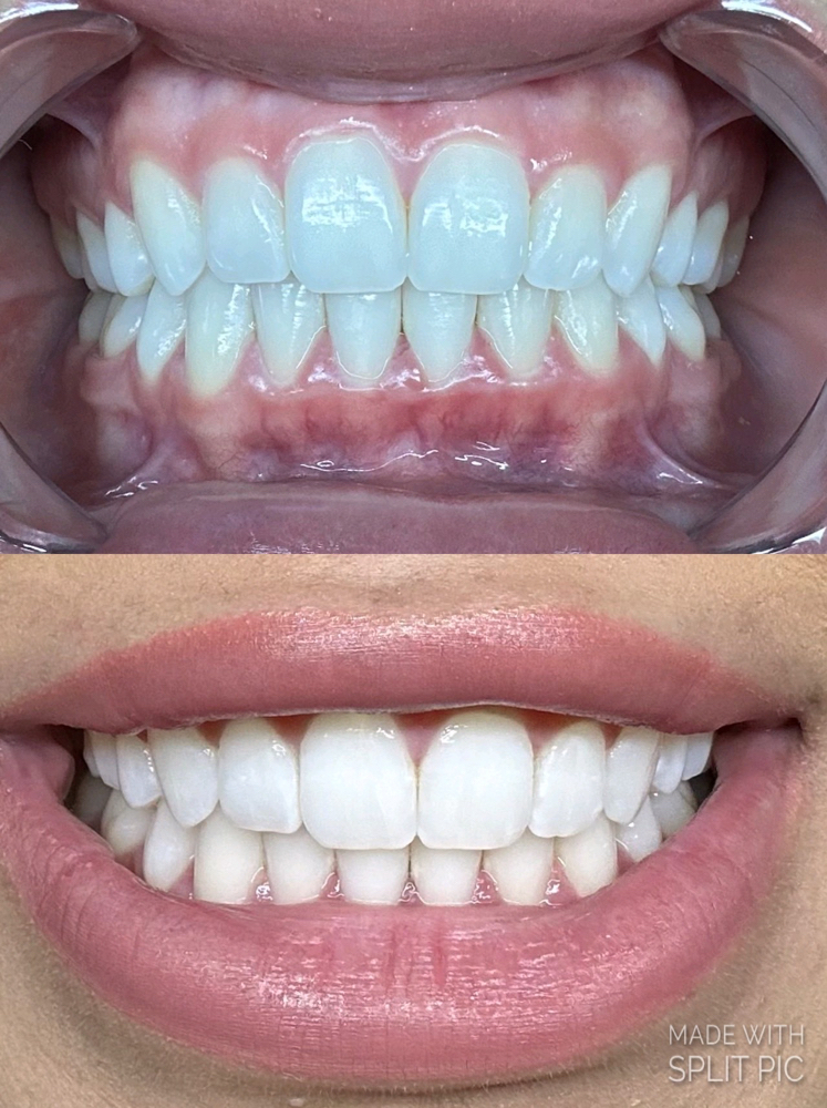 Teeth Whitening-30 Min
