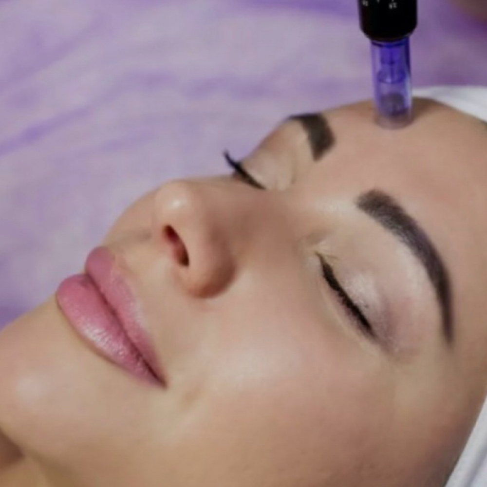 PRP Microneedling Treatment at Graceful Skin Aesthetics LLC in Glendale, AZ