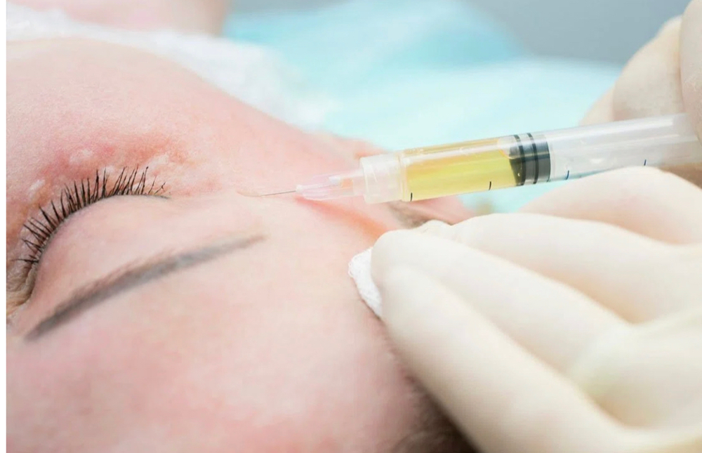 PRP Injection