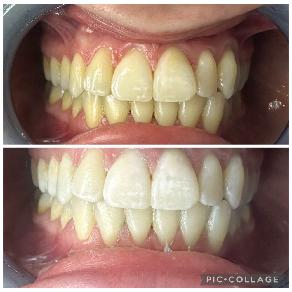 Teeth Whitening at House of Esthetics LLC in Casa Grande, AZ