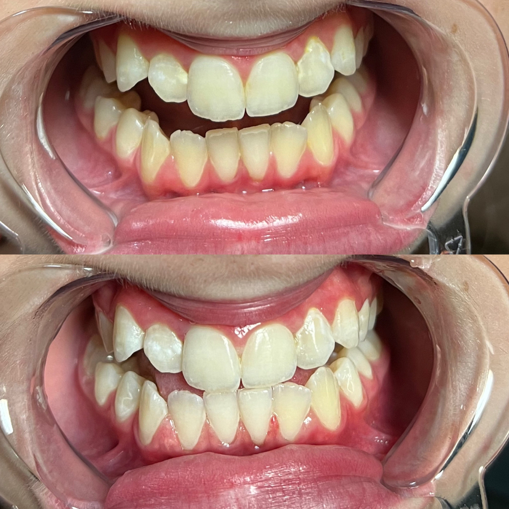 Teeth Whitening
