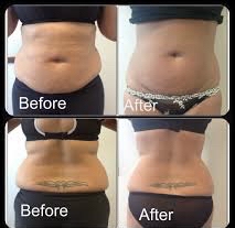 Cavitation + Laser Liposuction