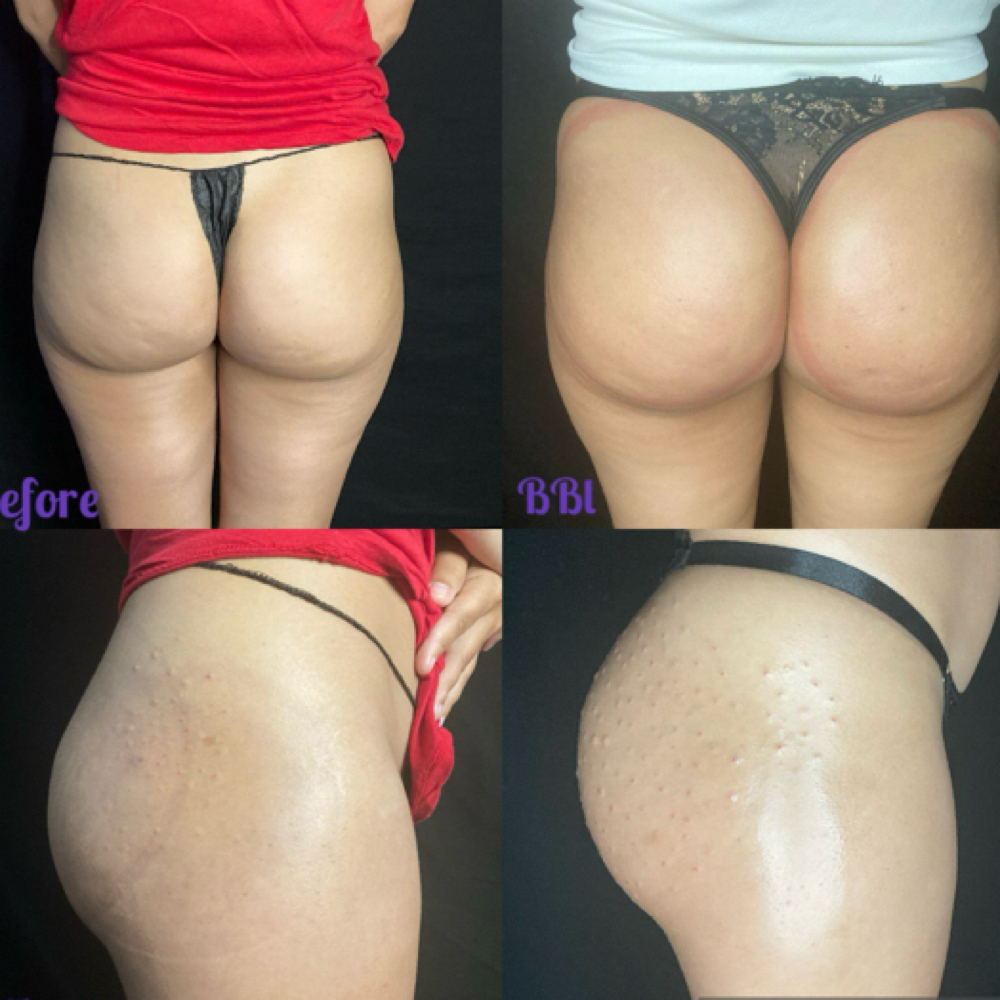 Peachy Booty Butt-Filler 120cc at Glo’s Beauty Creations