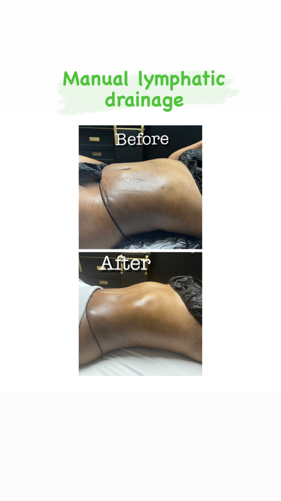 New Client (1 Use) Only Lymphatic at Wholistic Recovery & Wellness Spa in Snellville, GA