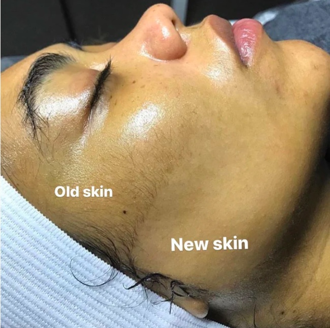 Dermaplaning Facial