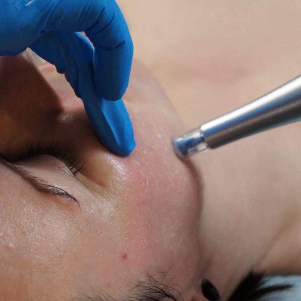 ✨NEW! NANO INFUSION FACIAL at Amy Shafer Aesthetics in Nashville, TN