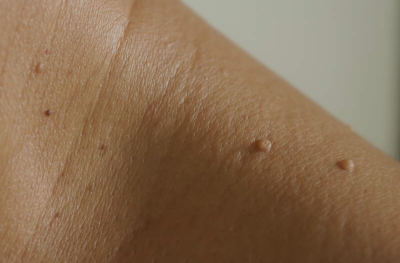 Skin Tag Removal at Mayumi Aesthetics in Covina, CA