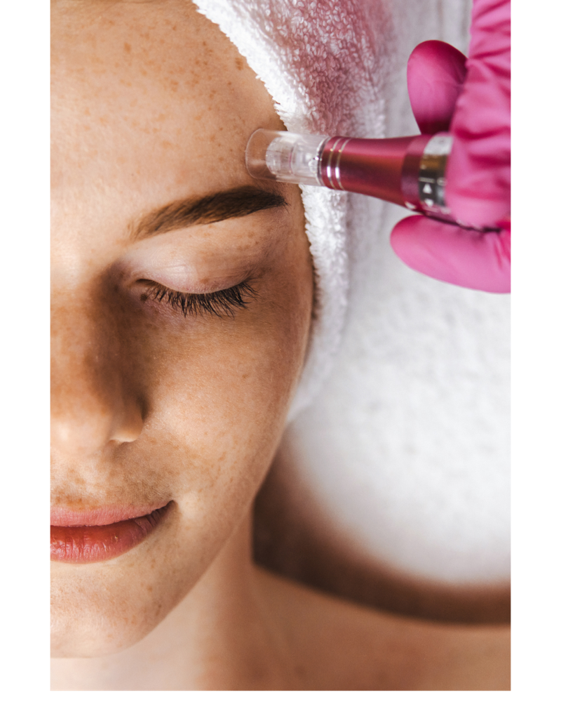 Microneedling
