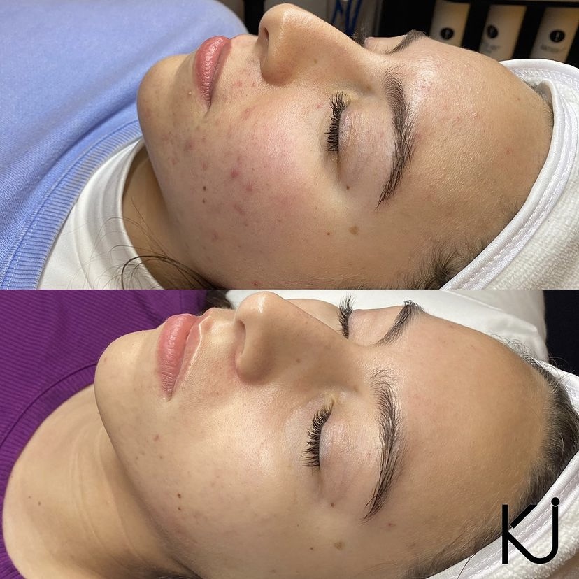 Acne Consultation W/Treatment & LED