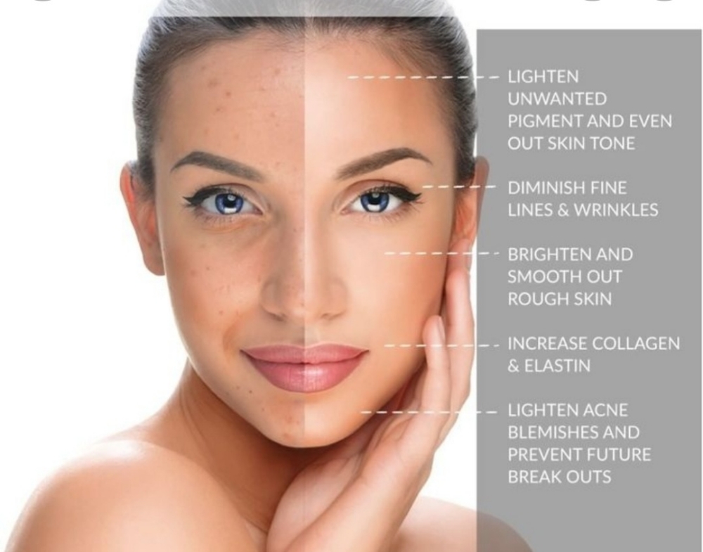 Chemical Peel