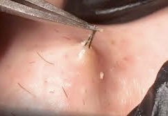 Ingrown Hair Removal