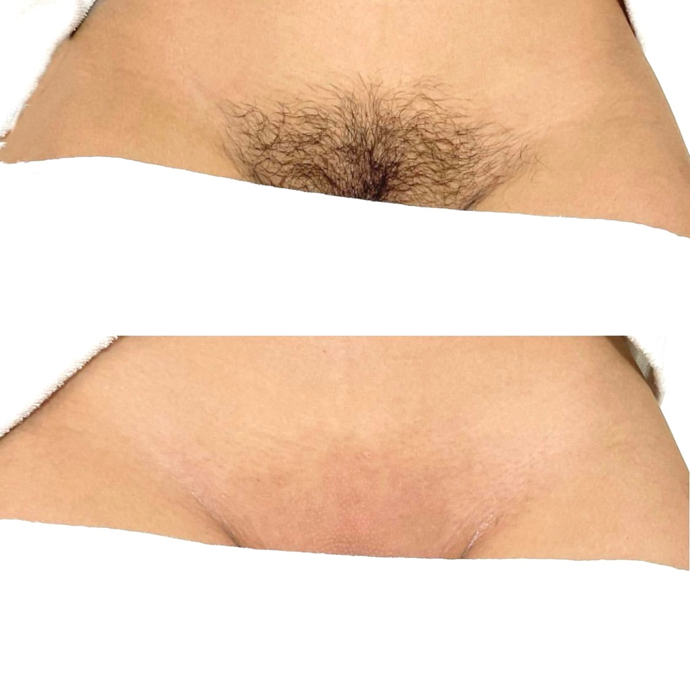 Brazilian Wax