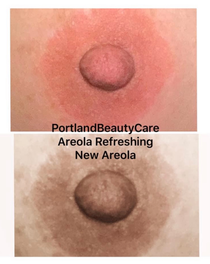 PMU/Areola Reconstruction/Reboost