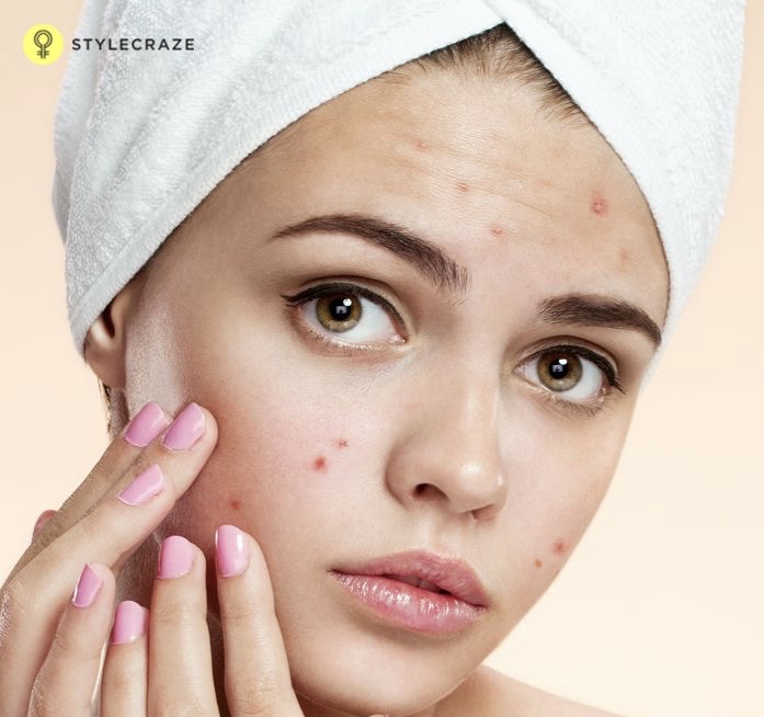 Teenage Acne Facial