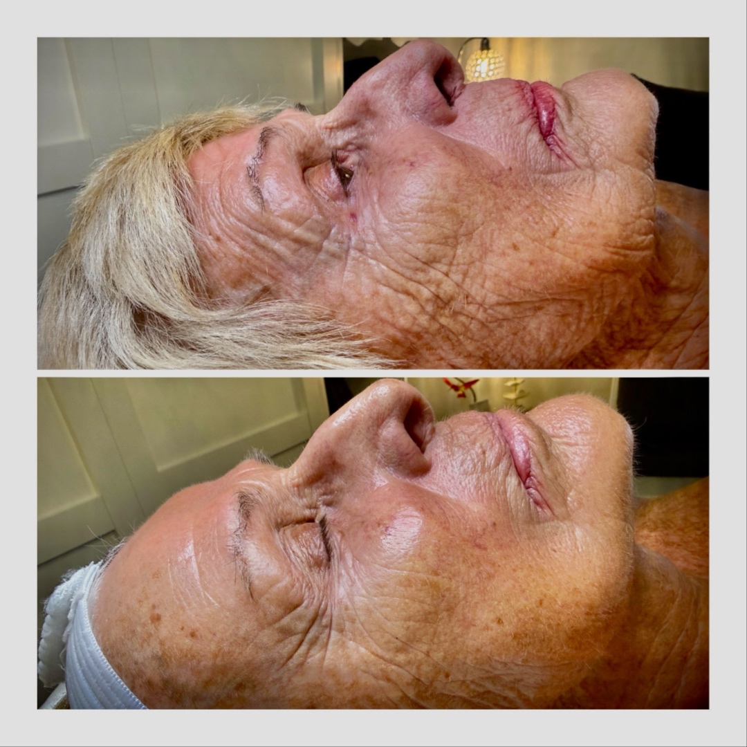 Customized Corrective Peel at Fitzskin in Gilbert, AZ