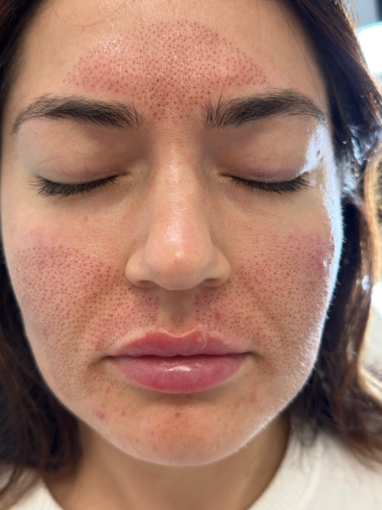 Butterfly Plasma Lift