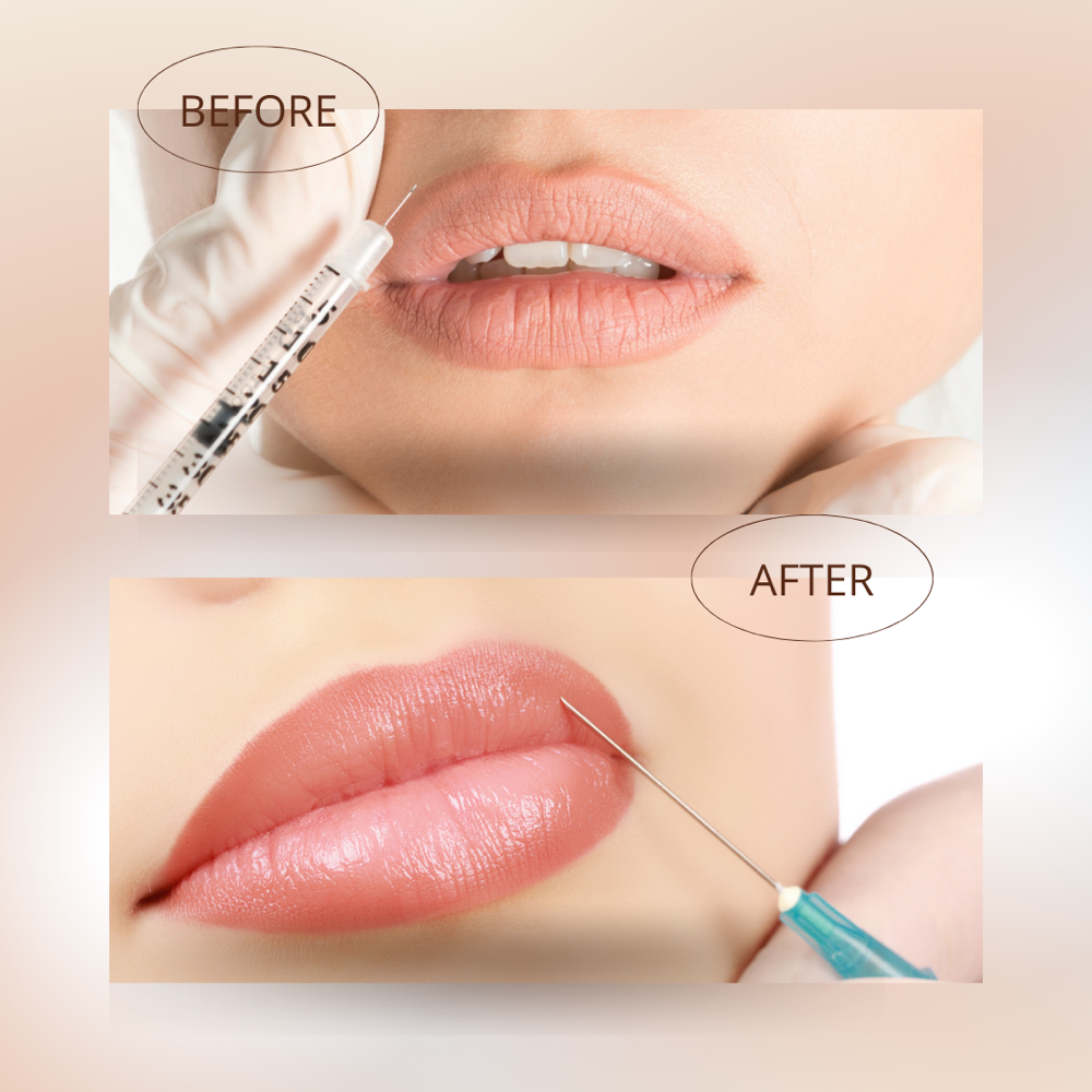 Botox Lip Flip- $95