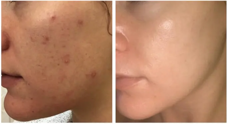 Chemical Peel /Skin Treatment