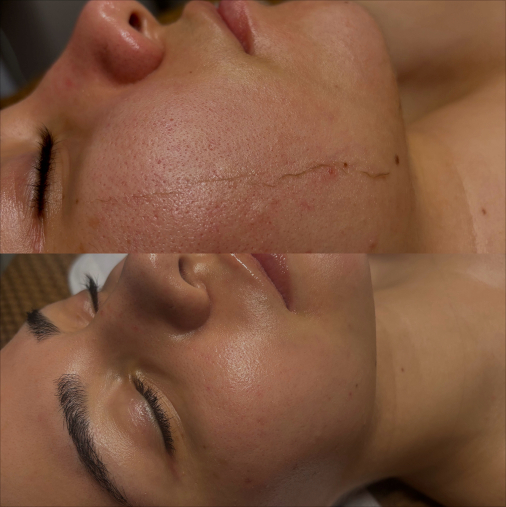 Dermaplaning Facial