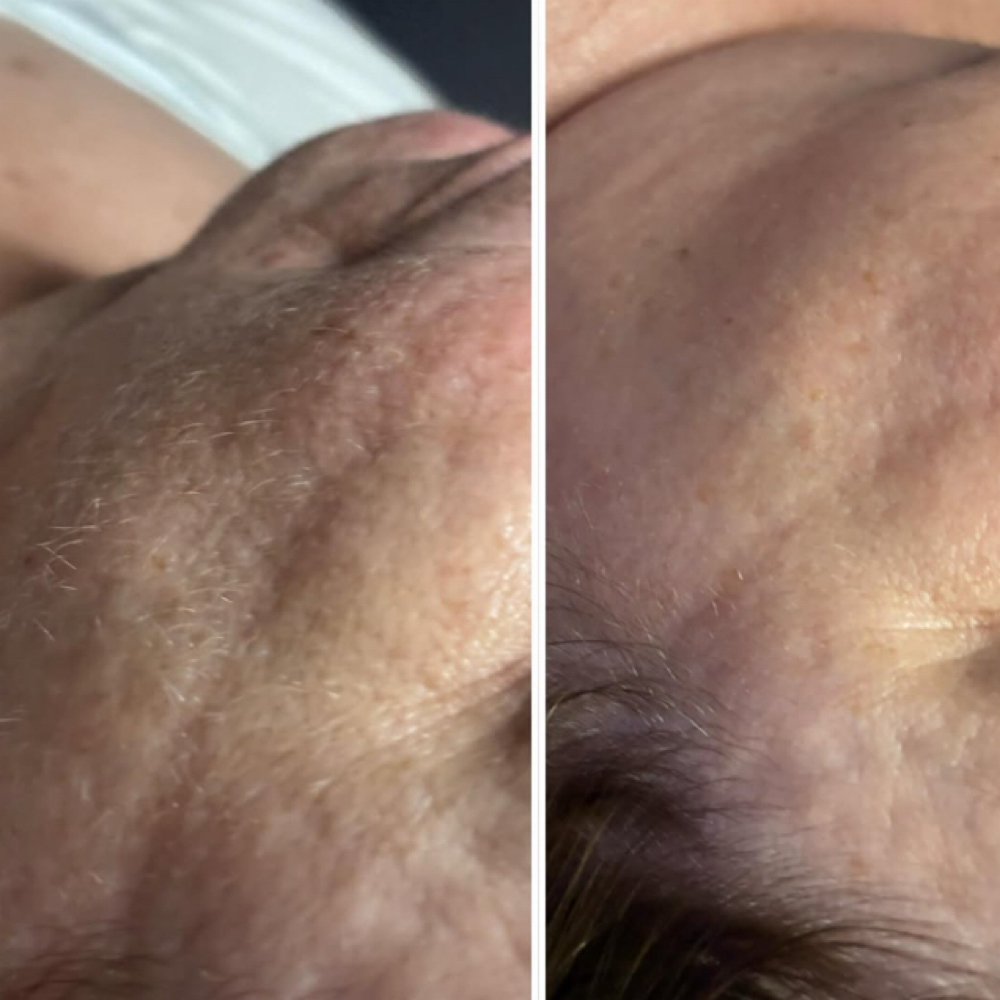 Dermaplane Facial at Hair Horizons in Schaumburg, IL