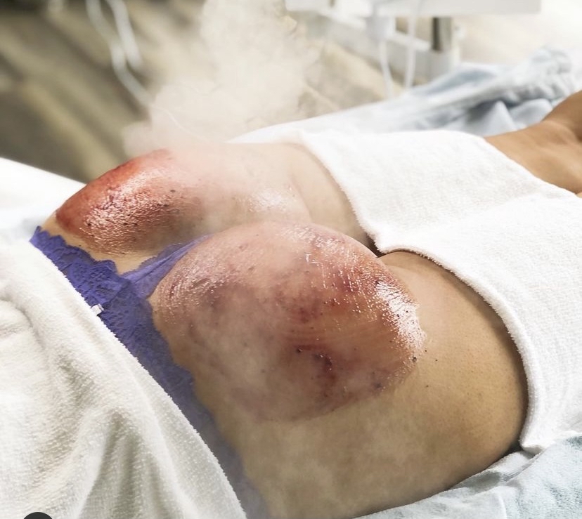 Butt Facial With Radio Frequency