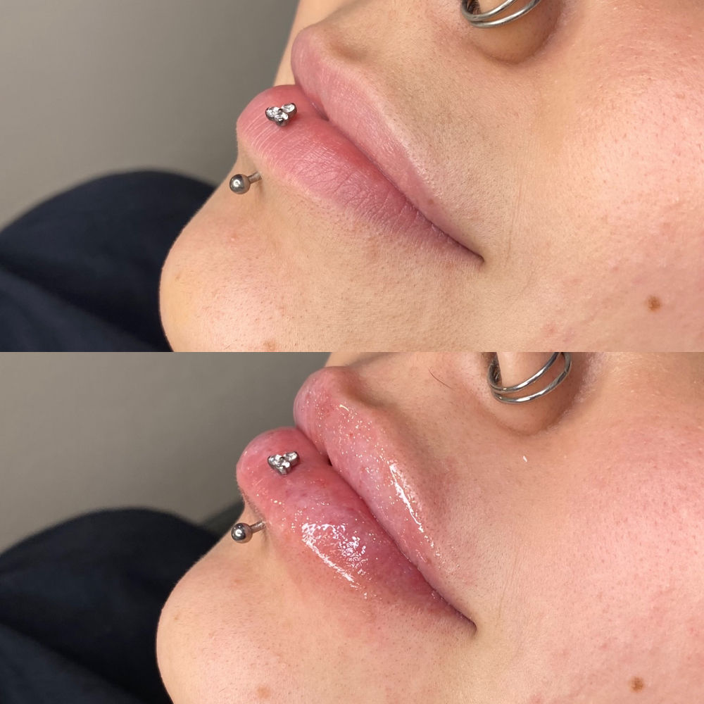 1ML HA Lip Filler