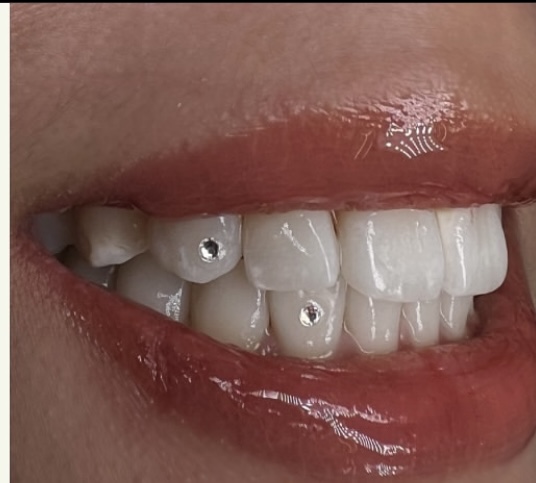 Tooth Gems at Xtraglazed Therapies and Locs in Richmond, VA