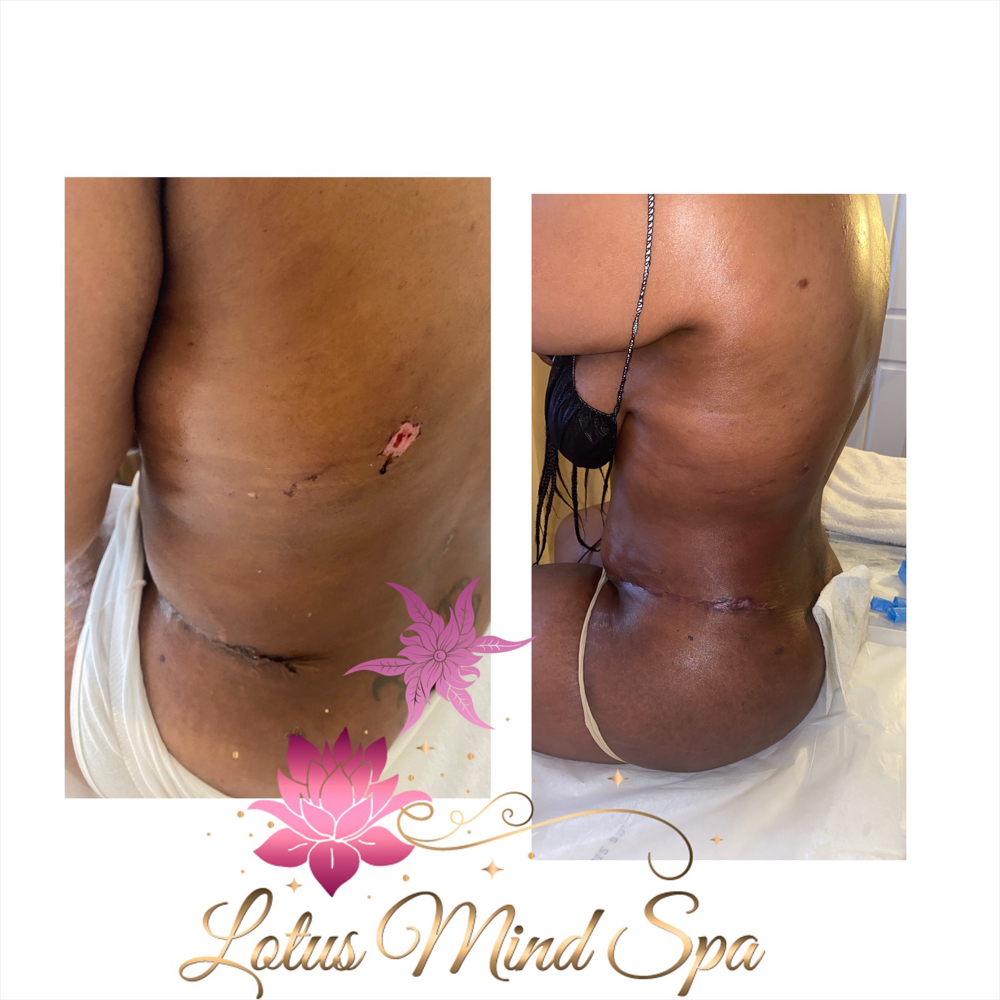 Lymphatic Massages