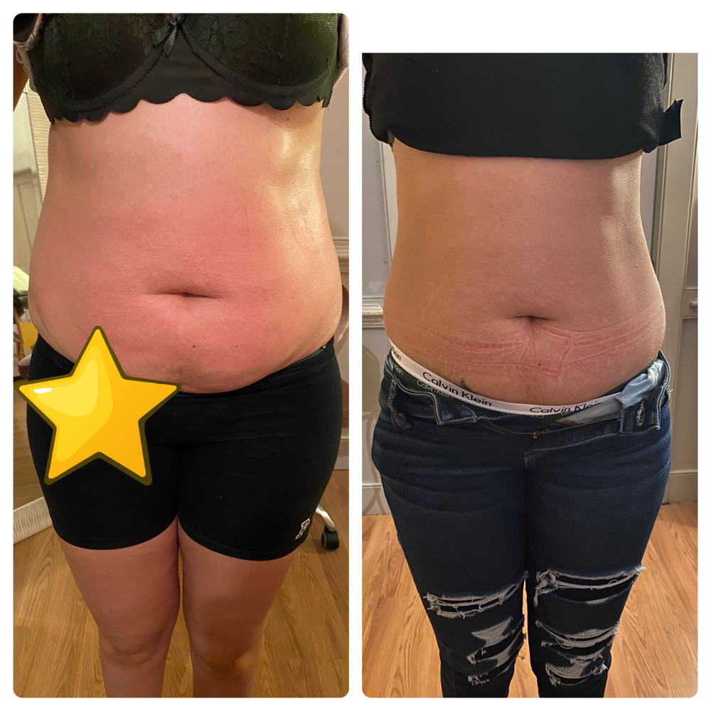 Body Sculpting
