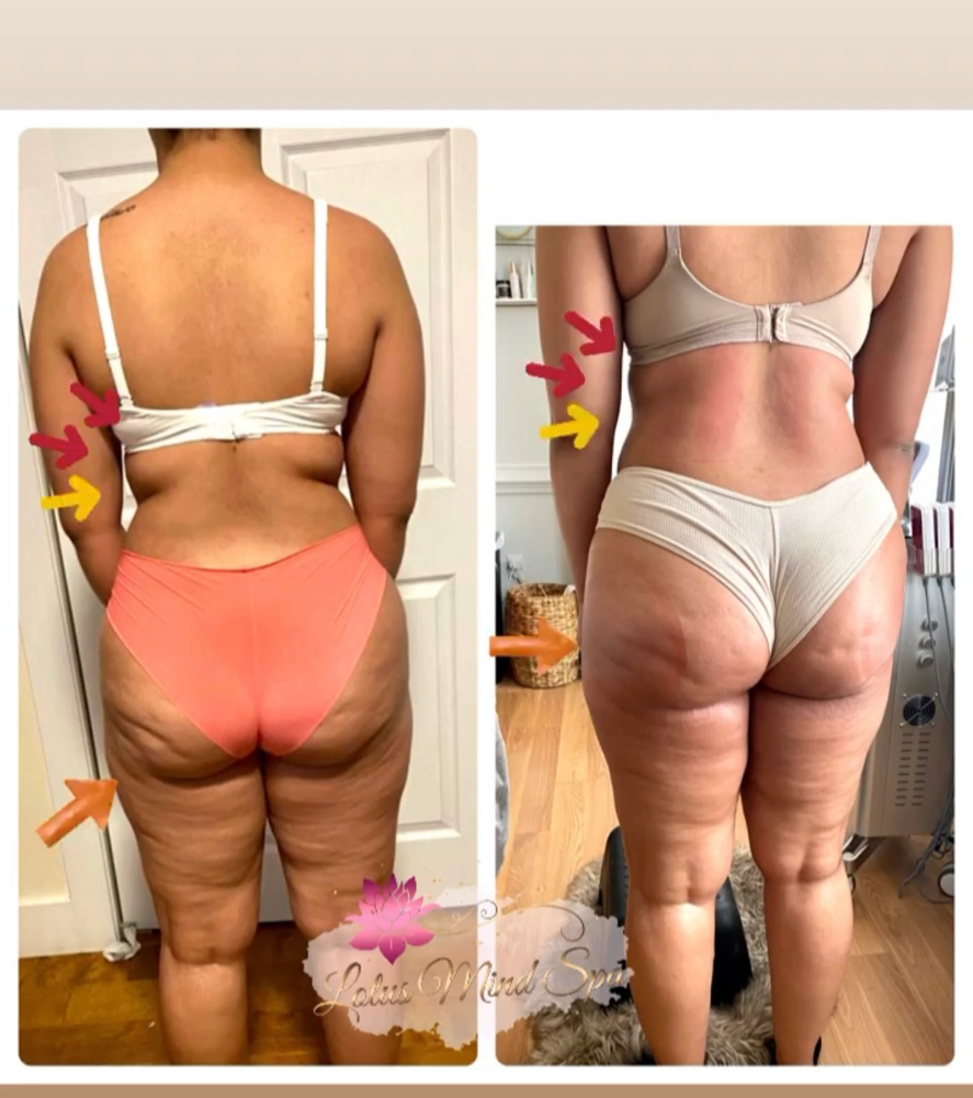 Cellulite Blaster