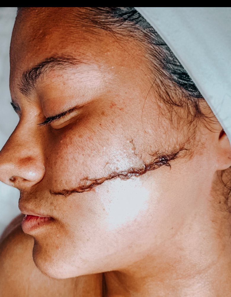 Dermaplaning