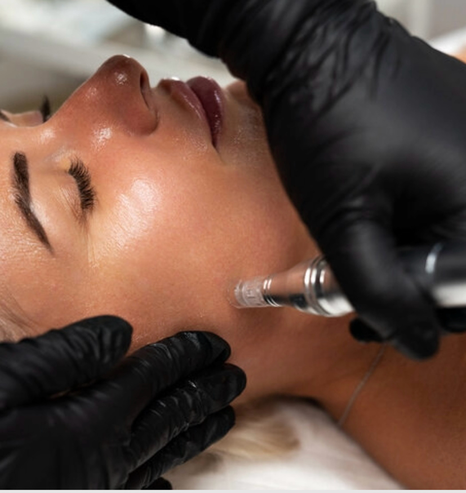Microneedling Treatment