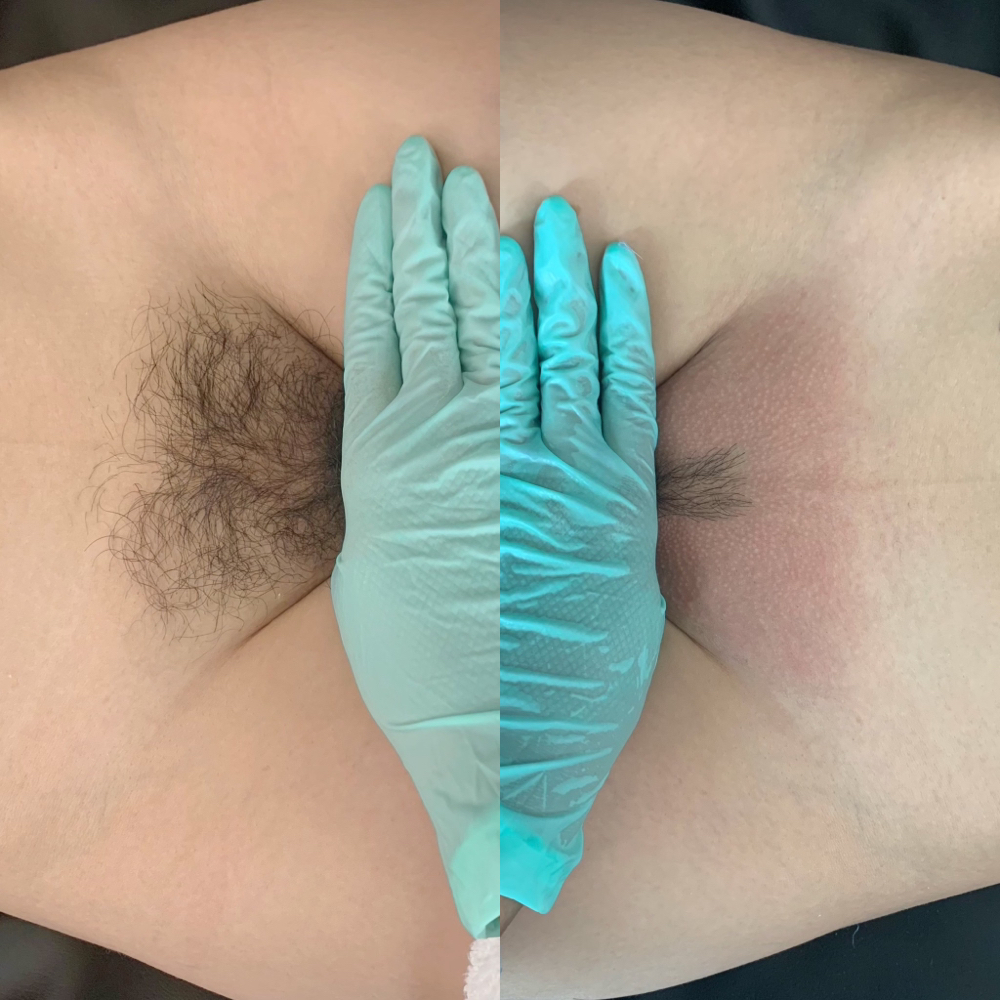 Brazilian Wax